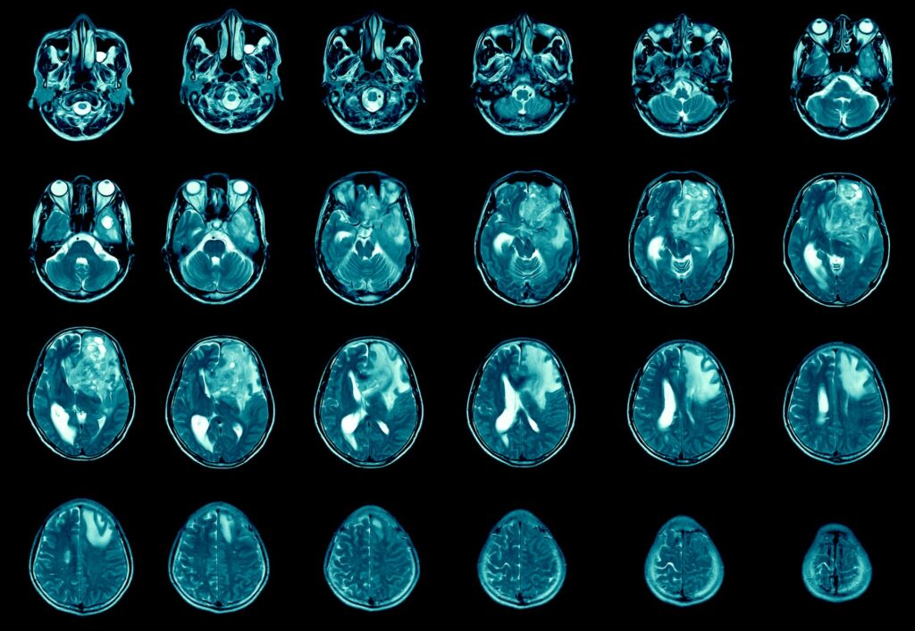 Melatonina: una aliada inesperada contra el tumor cerebral más agresivo